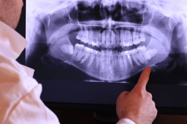 Best Knocked-Out Tooth (Avulsed Tooth) Treatment in Lake Jackson, TX